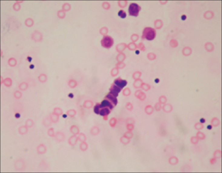 Pleural effusion of small cell carcinoma characterized by a cord of small malignant cells showing prominent nuclear molding (H and E, ×400)