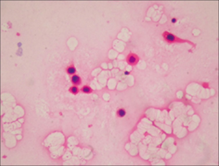 Pleural effusion of squamous cell carcinoma showing atypical epithelial cells with keratinizing cytoplasm (H and E, ×400)