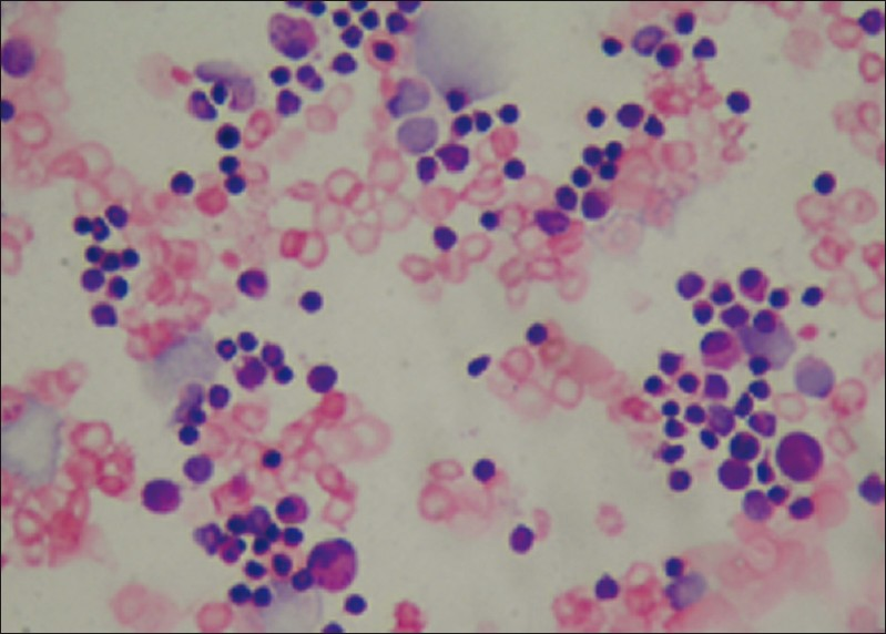 Pleural effusion of acute myeloid leukemia showing blasts and karyorrhic cells (Giemsa stain, ×400)