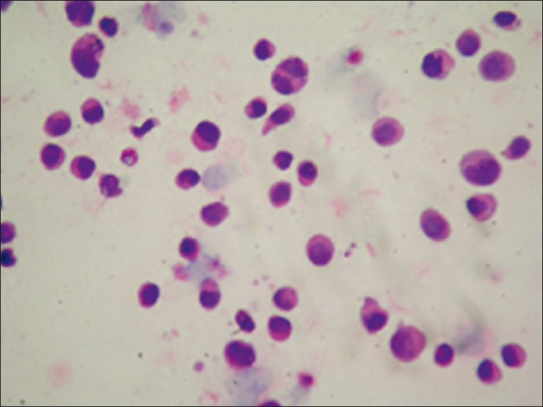 Multiple myeloma characterized by immature plasma cells (H and E, ×400)