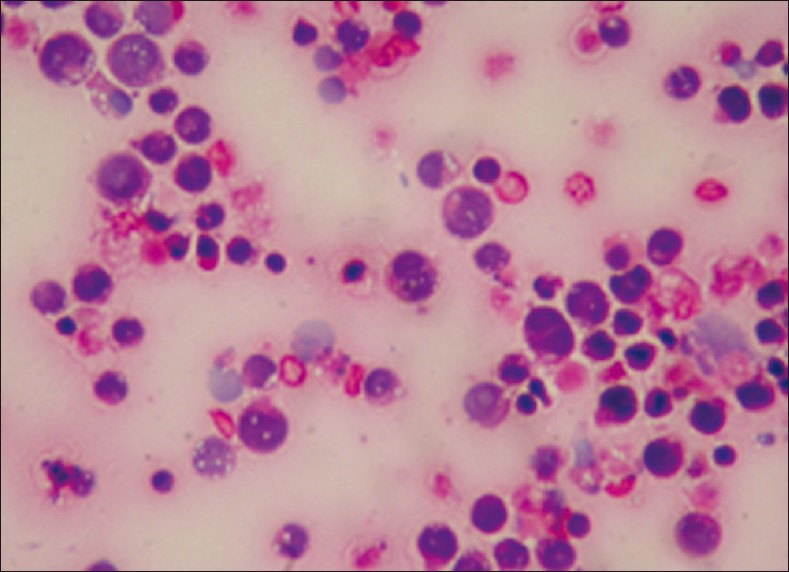 Single atypical lymphoid cells showing karyorrhexis and mitosis in a case of diffuse B large cell lymphoma (Giemsa stain, ×400)