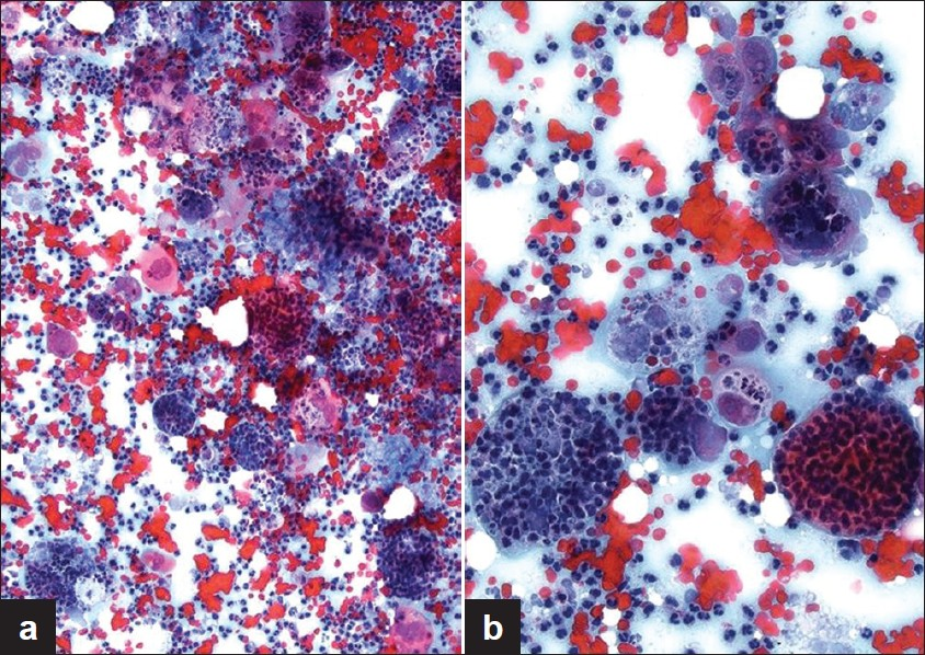 Cytology smear showing salivary gland tumor cells packed with neutrophils at (a) intermediate and (b) high magnification. Note the abundance of neutrophils in the background (Pap stain, magnification (a) ×100 and (b) × 200)