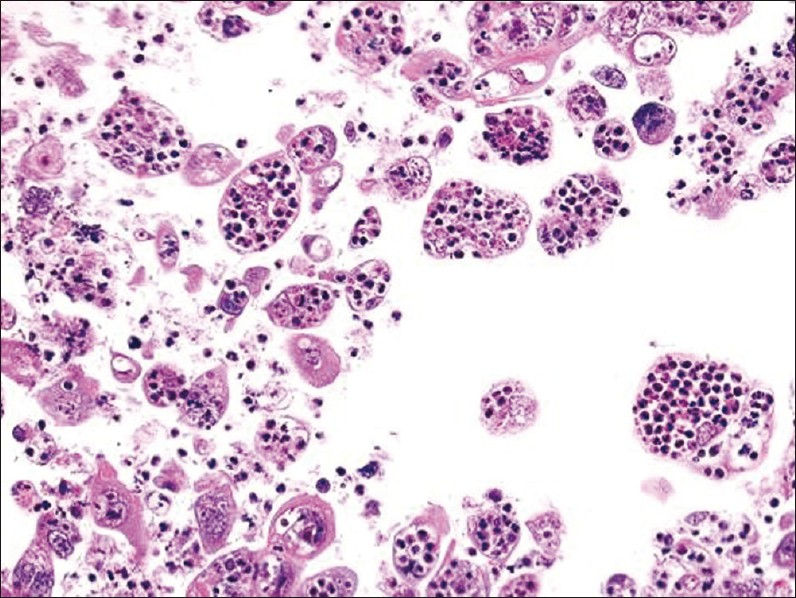 Cell block of FNA material showing striking tumor cell cannibalism of neutrophils (H and E stain, magnification ×200)