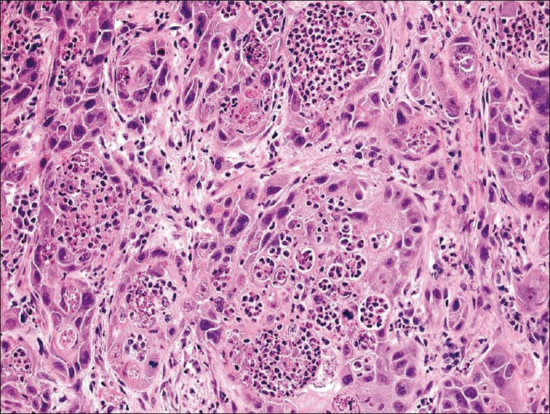 Salivary duct carcinoma from the surgical excision showing marked neutrophil-tumor cell cannibalism (H and E stain, magnification ×200).