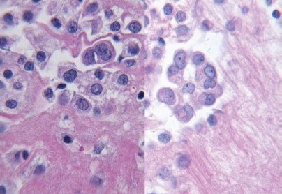 Hyperchromatism from traditional processing (left) and fine nuclear chromatin from microwave processing (right) (H and E stain, 60×)