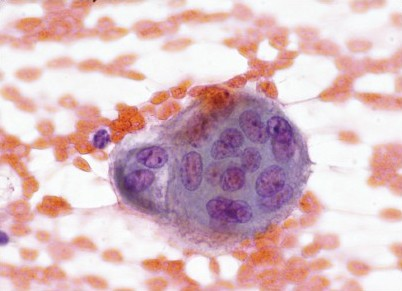 MNH at 600× (Pap stain)