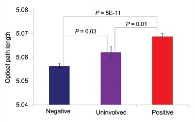 Optical path length parameter shown for morphologically benign and malignant urothelial cells