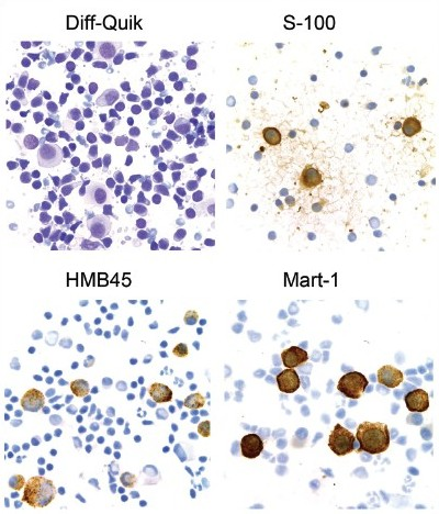 Application of immunocytochemistry to direct smears of metastatic melanoma