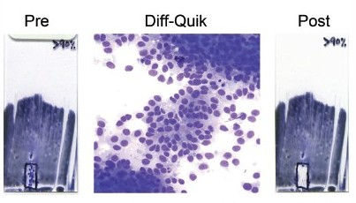 Microdissection of tumor cell–enriched areas from Diff-Quik® stained direct smears of melanoma