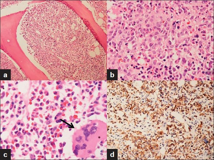 (a) Bone marrow biopsy showing more than 90% cellularity. There is partial replacement of normal marrow with blasts (H and E, ×100); (b) The blasts have scant to moderate cytoplasm with prominent nucleoli (H and E, ×400); (c) Occasional multinucleated dysplastic megakaryocyte was also noted (arrow) (H and E, ×400); (d) Blasts showing strong cytoplasmic positivity CD 61, IHC (×400):