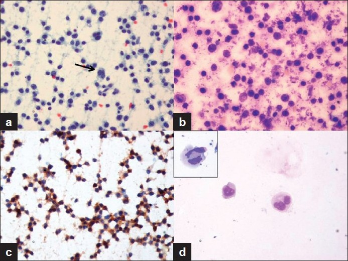 (a) Blasts varying in size from medium to large, having scant to moderate granular cytoplasm, fine nuclear chromatin and single to multiple prominent nucleoli. Occasional larger cells, having abundant cytoplasm and lobated nuclei (arrow) Papanicolaou (×200); (b) Anucleate pale blue shredded cytoplasmic fragments in the background demonstrated better in low cellularity areas MGG (×400); (c) Blasts immunopositive for CD 61 ICC (×400); (d) Bi and multinucleate forms on cytocentrifuge preparation of the CSF specimen; (inset) binucleate cell mimicking megakaryocyte MGG (×400)