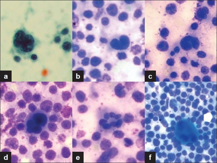 (a) Large cell with moderate amount of granular cytoplasm and a single nucleus showing multiple lobations Papanicolaou (×400); (b) Cell having horse shoe shaped nucleus and dusky cytoplasm MGG (×400); (c) Another cell showing nuclear indentation and early lobulation MGG (×400); (d,e,f) Multinucleated cells with abundant cytoplasm and nuclear lobations resembling immature megakaryocytes MGG (×400)