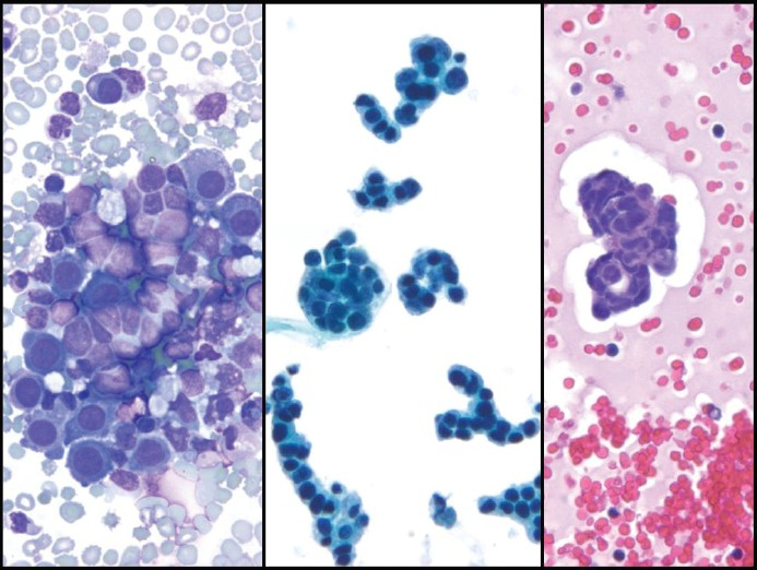 Small-cell carcinoma with a predominance of large clusters in pleural fluid. The cells have wrapped themselves around one another forming large cell clusters (left, Pap stain, ×400). Cell block (right, H and E, ×200) shows a lacuna around large clusters with hollow cores and pseudo-lumen caused by tumor cell necrosis. Synaptophysin immunostain (right lower, x400) confirms neuroendocrine differentiation in these tumor cells