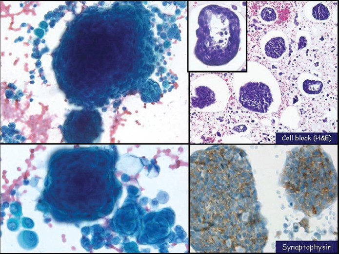 Small-cell carcinoma with a predominant single-cell pattern mimicking lymphoma in pleural fluid. The nuclei show a finely distributed granular chromatin texture and small nucleoli, left and middle (Pap stain, left ×200 and middle ×400). Chains of small cells with nuclear molding (middle, center of the image) and karyorrhexis (left) are seen. In cell block sections (right, H and E stain, ×400) tumor cells display a discohesive pattern