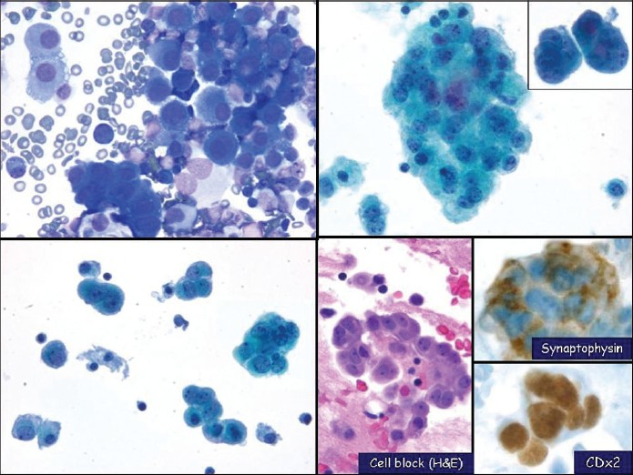 Large cell neuroendocrine carcinoma with prominent nucleoli shown in pleural fluid. The malignant cells have prominent nucleoli, nuclear enlargement and atypia. The cells also have a moderate amount of cytoplasm. (left upper, DQ cytospin, x400; left lower & right upper, Pap stain, x400; right lower, cell block H and E, x400; right lower, synaptophysin (top, x400) and CDX2 (bottom, x400) immunostains)