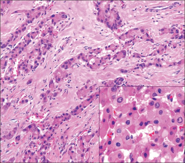 Low-power view of fibrolamellar variant of hepatocellular carcinoma (hematoxylin and eosin [H and E]), with cords of tumor cells separated by bands of fibrous tissue. The inset shows a higher power image (H and E), which better demonstrates the abundant eosinophilic granular cytoplasm, cytoplasmic pale bodies and nuclei with prominent nucleoli