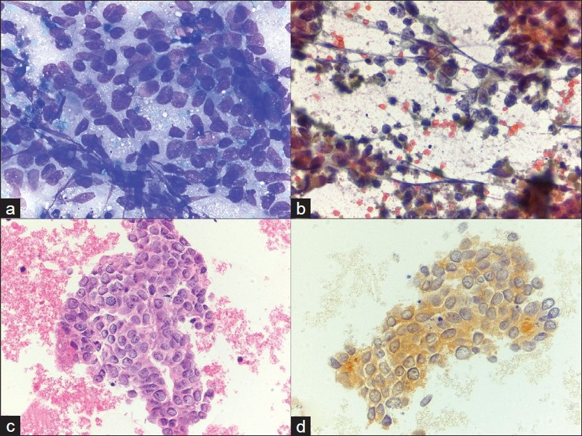 Metastatic prostatic adenocarcinoma. a) Many pleomorphic epithelioid cells with increased nuclear to cytoplasmic ratios are occasionally arranged in an acinar-like formation (40×, Diff-Quik stain); b) Eccentric nuclei with highly prominent macronucleoli, coarsely clumped chromatin, and irregular outlines are highlighted (40×, Papanicolaou stain); c) Cell block material demonstrates a gland like configuration with prominent nucleoli (H and E, 20×), d) A PSA immunostain is expressed, supporting the diagnosis of metastatic prostatic adenocarcinoma (40×, immuno)