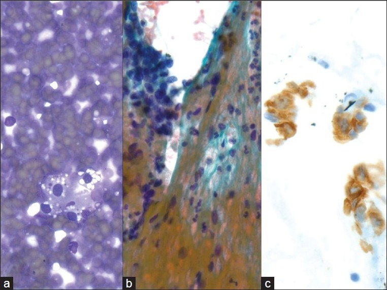 Metastatic renal cell carcinoma. a) Cluster of round cells, with uniform nuclei and vacuolated cytoplasm with ‘punched out’ holes (40×, Diff-Quik stain), b) Large, cohesive clusters of uniform epithelial cells are seen traveling with endothelial cells and stromal components (40×, Papanicolaou stain), c) An RCC immunostain is focally expressed, supporting the diagnosis of metastatic renal cell carcinoma (40×, immuno)