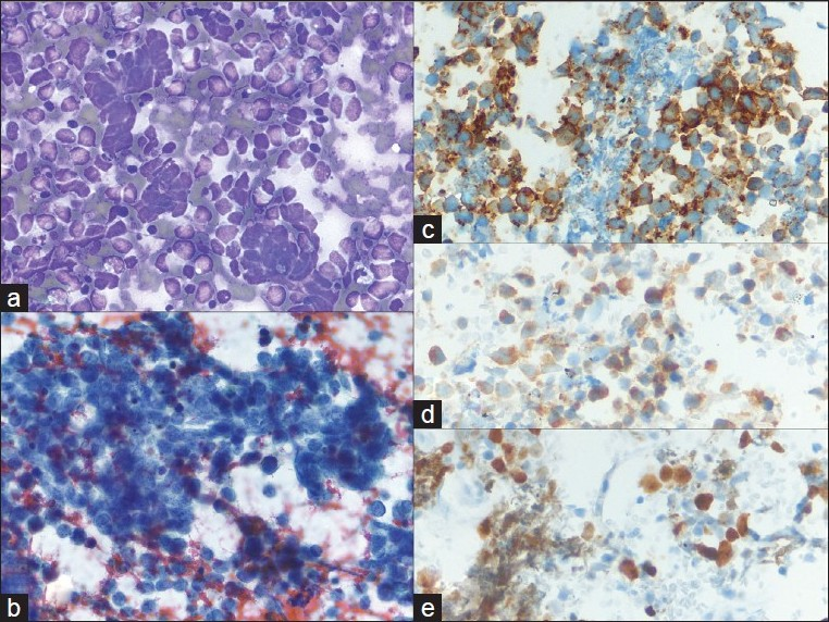 Metastatic small cell carcinoma of the lung; a) Many loose, small, mildly pleomorphic cells with high nuclear to cytoplasmic ratios are seen. Some cells are densely crowded into small clusters with nuclear molding (40×, Diff-Quik stain); b) Round nuclear outlines, absent or minimal nucleoli, and smooth, dark chromatin (40×, Papanicolaou stain); c-e) CD56, synaptophysin and Ki67 are expressed, supporting the diagnosis of metastatic small cell carcinoma (40×, immuno)