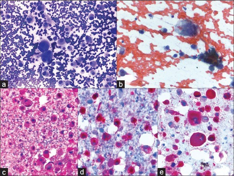 Metastatic melanoma; a) A very loose collection of giant cells, multinucleated cells and large pleomorphic cells with a plasmacytoid appearance (40×, Diff-Quik stain); b) Hyperchromatic, coarsely clumped nuclear chromatin with very irregular nuclear outlines. The cytoplasm contains dusty pigmentation (40×, Papanicolaou stain); c-e) S-100, HMB45, and melanin A are strongly expressed (40×, immuno)