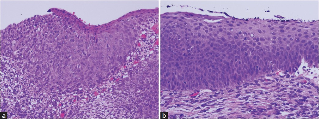 a) A 16-year-old girl had high-grade squamous intraepithelial lesion (HSIL) on cervical cytology, and the cervical biopsy was severe squamous dysplasia (A, 200×, H and E), b) She underwent LEEP but with positive resection margins. She had two times HSIL cervical cytology during 15-month follow-up, and underwent for the second LEEP for moderate squamous dysplasia (B, 200×, H and E).