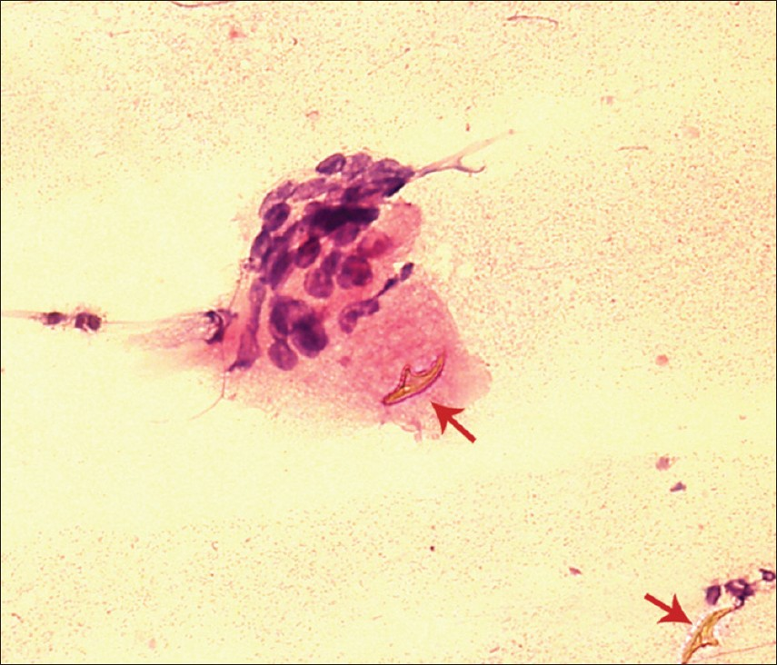 A foreign body giant cell neighboring a hooklet and another hooklet in the lower right corner (red arrow) (H and E stain, ×400)