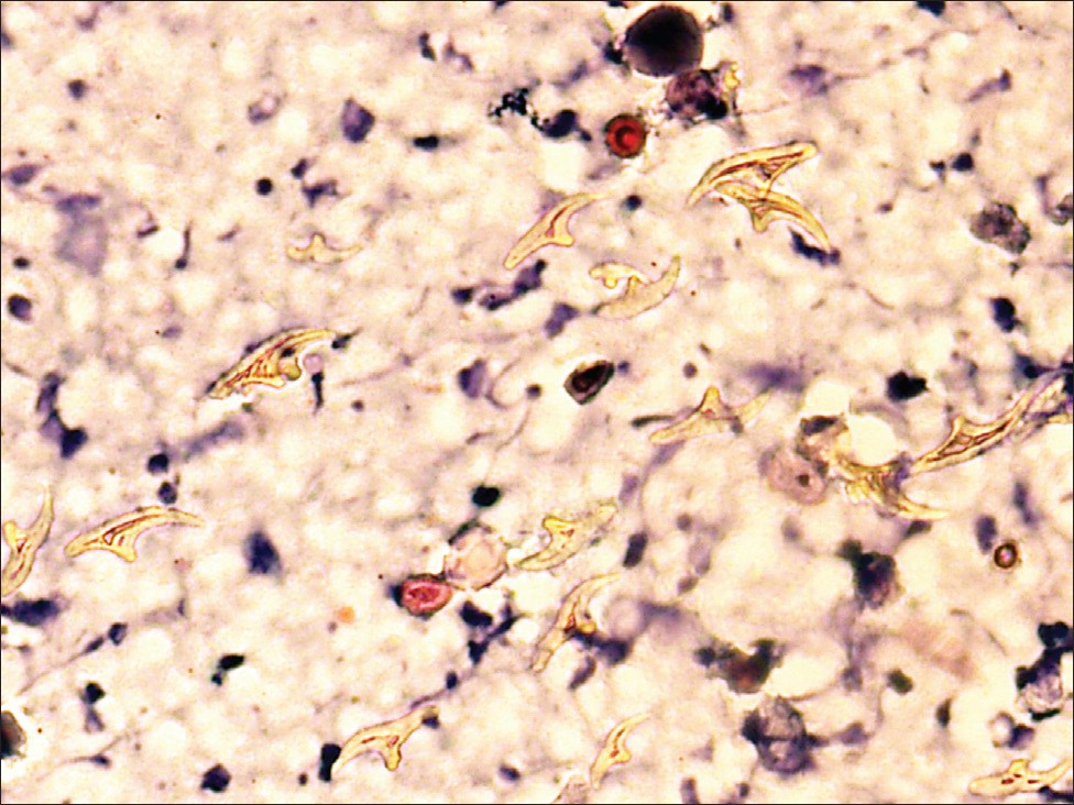 Numerous free hooklets in the inflammatory background (H and E stain, ×400)