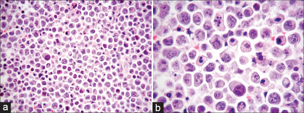 (a) Cell block of FNA material showing a striking nuclear pleomorphism as well as a high mitotic index with irregular mitoses and numerous apoptotic bodies (H and E stain, magnification ×200). (b) Higher magnification of the a, with particular emphasis on the details noted above (H and E stain, magnification ×400)