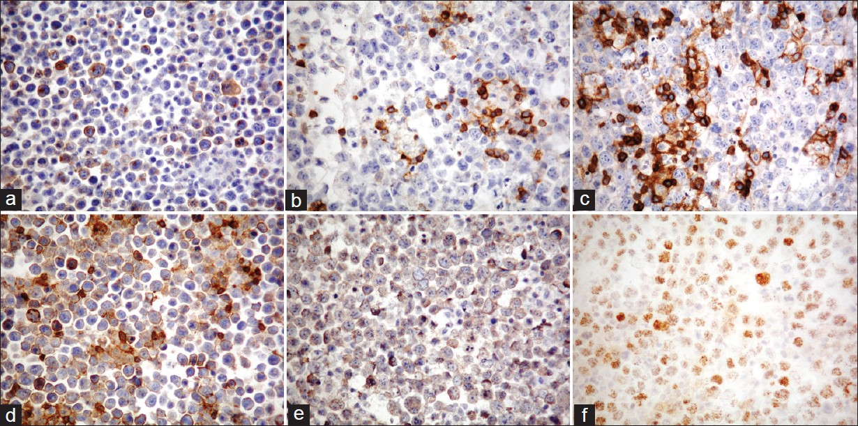 The performed immunocytochemistry (ICC) revealed among others, a positive reaction in the neoplastic cell population for (a) CD30 (magnification ×200), (b) CD43 (magnification ×200), (c) CD45 (magnification ×200), (d) CD45RO (magnification ×200), (e) EMA (magnification ×200), and (f) HHV-8 [LANA-1] (nuclear staining; magnification ×200)