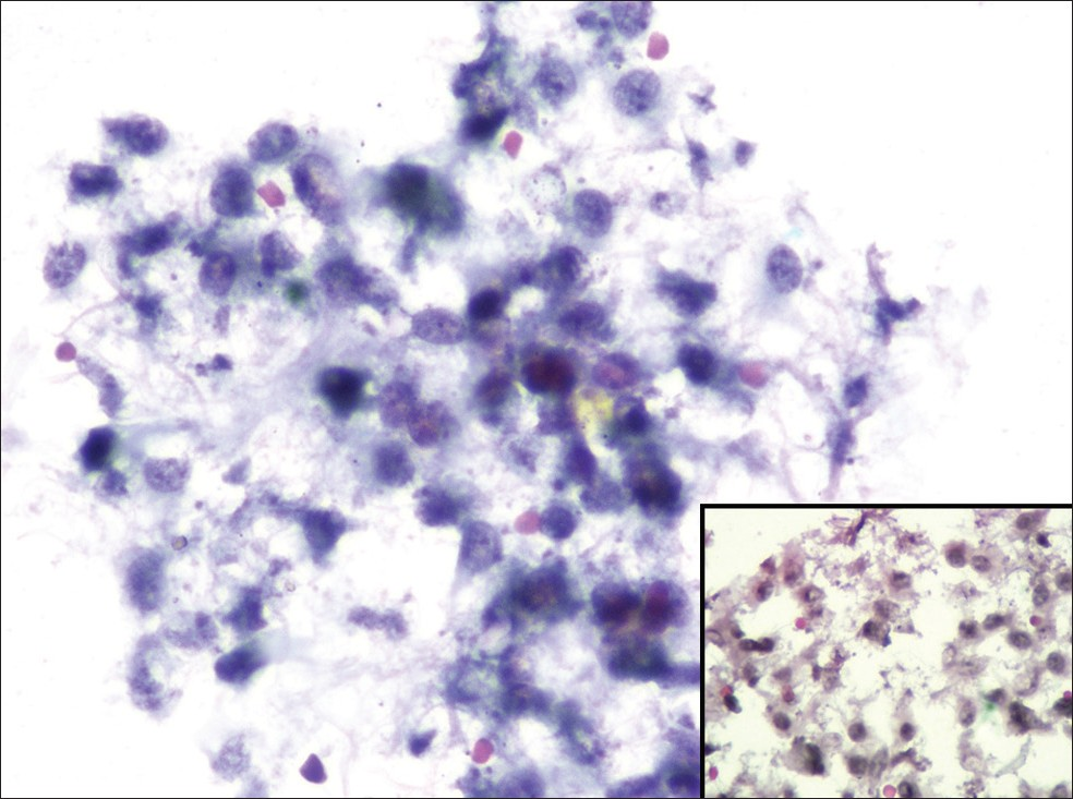 Cytology smears showing moderate cellularity, cells present in clusters (Papanicolaou, ×40) and inset shows dispersed cells with paracentral nuclei (Papanicolaou, ×40)