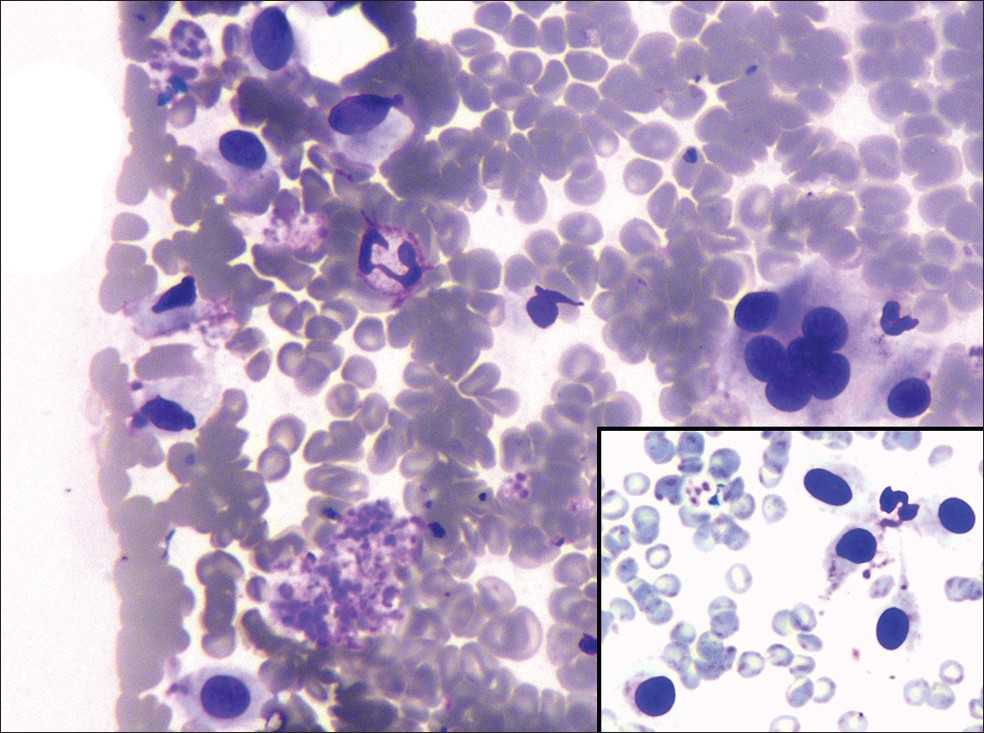 Cytology smears showing dispersed cells and few cells arranged in rosette-like structure (Giemsa, ×40) and inset shows dispersed cells with paracentral nuclei (Giemsa, ×40)