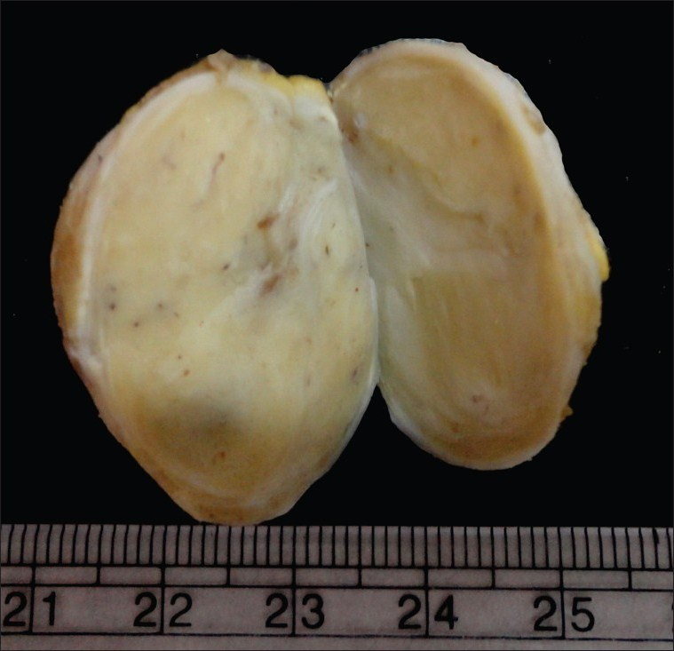 Gross specimen showing a well-circumscribed, encapsulated mass with a homogenous cut surface