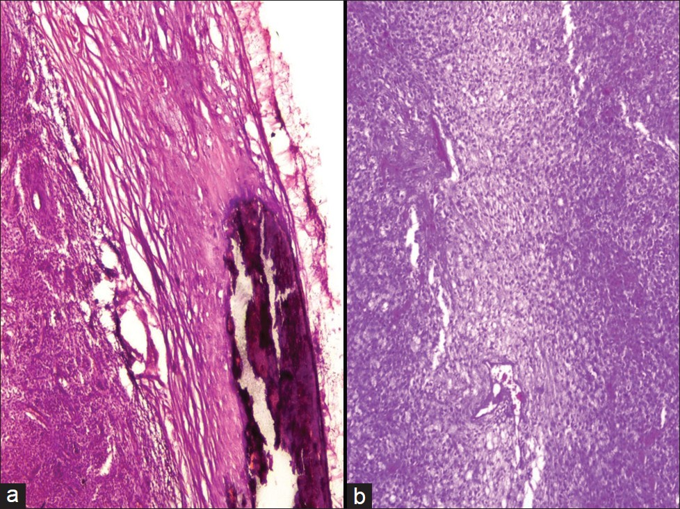 (a) Section showing tumor with calcification in the capsule (H and E, ×10) (b) Section showing tumor cells arranged in diffuse sheets (H and E, ×10)