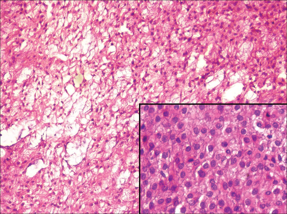 Section showing tumor cells embedded in myxoid stroma (H and E, ×10) and inset shows rounded-to-ovoid cells with vesicular nuclei and moderate cytoplasm (H and E, ×40)