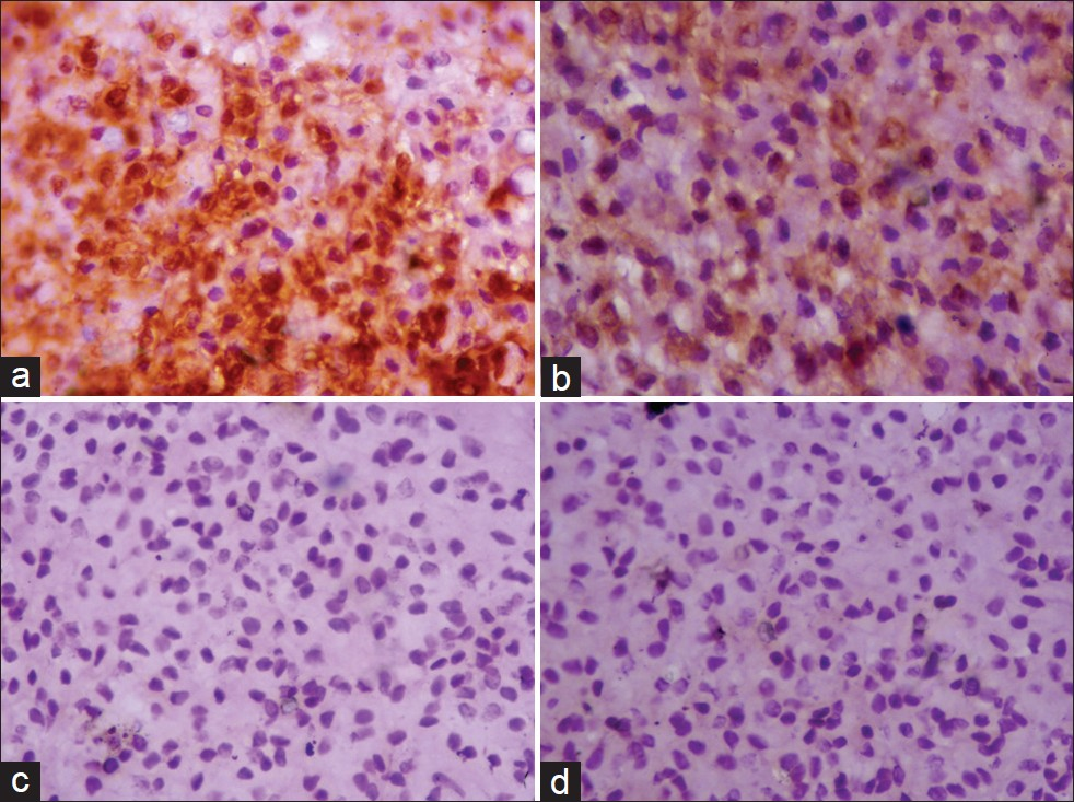 (a) Section showing cytoplasmic and nuclear S-100 positivity in tumor cells (S-100, DAB, ×40) (b) Section showing focal vimentin positivity in tumor cells (Vimentin, DAB, ×40) (c) Section showing tumor cells negative for CK (CK, DAB, ×40) (d) Section showing tumor cells negative for SMA (SMA, DAB, ×40)