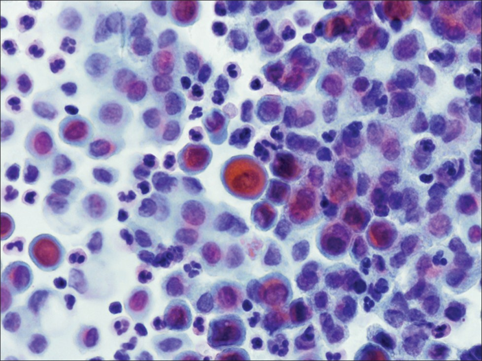 Mimickers of PK-like cells. Cells that had orangeophilic cytoplasm, but lacked degenerated pyknotic nuclei or cells with eosinophilic cytoplasm (regardless of nuclear structure) were not counted as PK-like cells. These mimicker cells typically had a rim of blue staining cytoplasm (Pap stain, ×400)