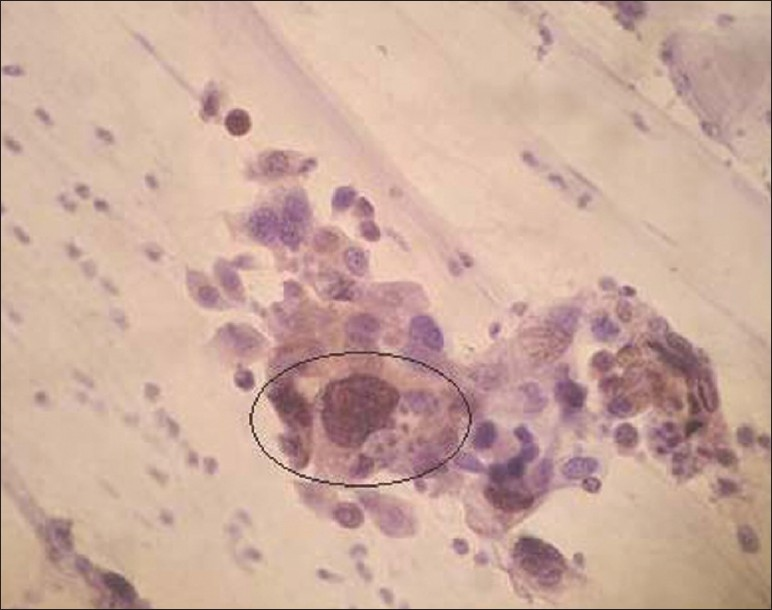 Positive P16INK4A immunoexpression seen in ASC-H (×400 magnification)