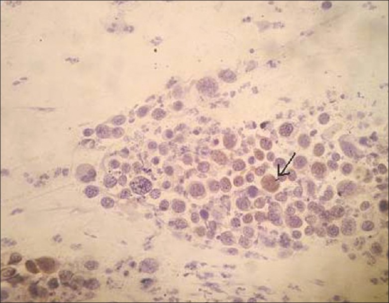 Positive P16INK4A staining (as depicted by arrow) in a cytologically diagnosed HSIL (CIN III) (×200 magnification)