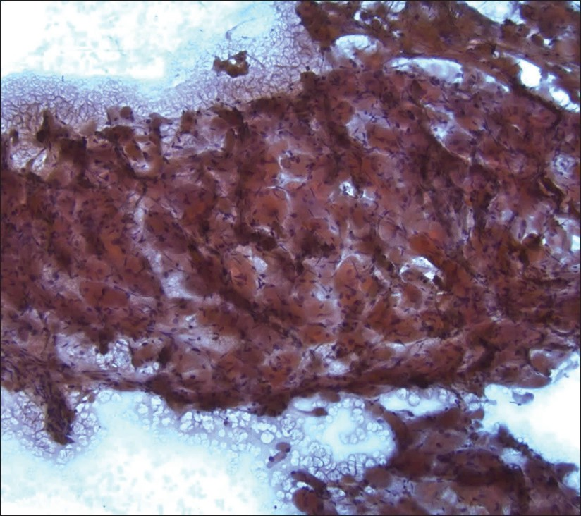 Adult rhabdomyoma. The lesional tissue had a striking resemblance to skeletal muscle on low-power magnification (Papanicolaou stain, 100×)