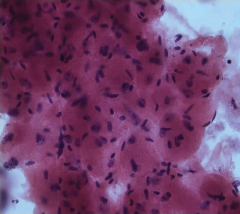 Adult rhabdomyoma. The cells exhibited abundant eosinophilic dense cytoplasm and peripherally located nuclei with vesicular chromatin and prominent nucleoli (H and E stain, cytospin preparation, 400×)