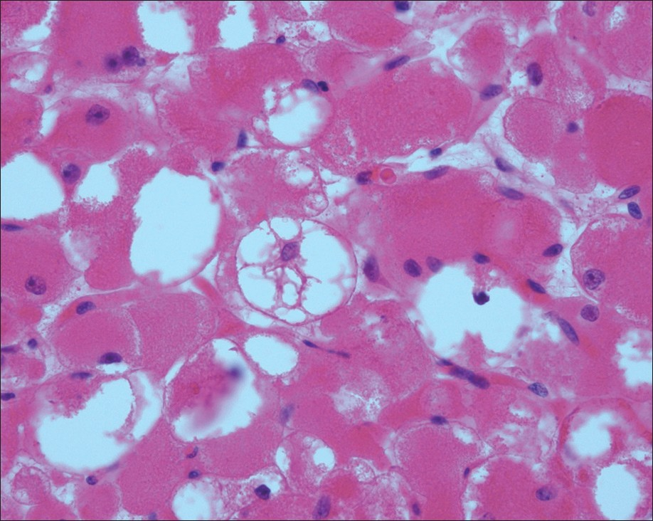 Adult rhabdomyoma. “Spider cells” as seen on the histologic section of the surgical specimen (H and E stain, 400×)