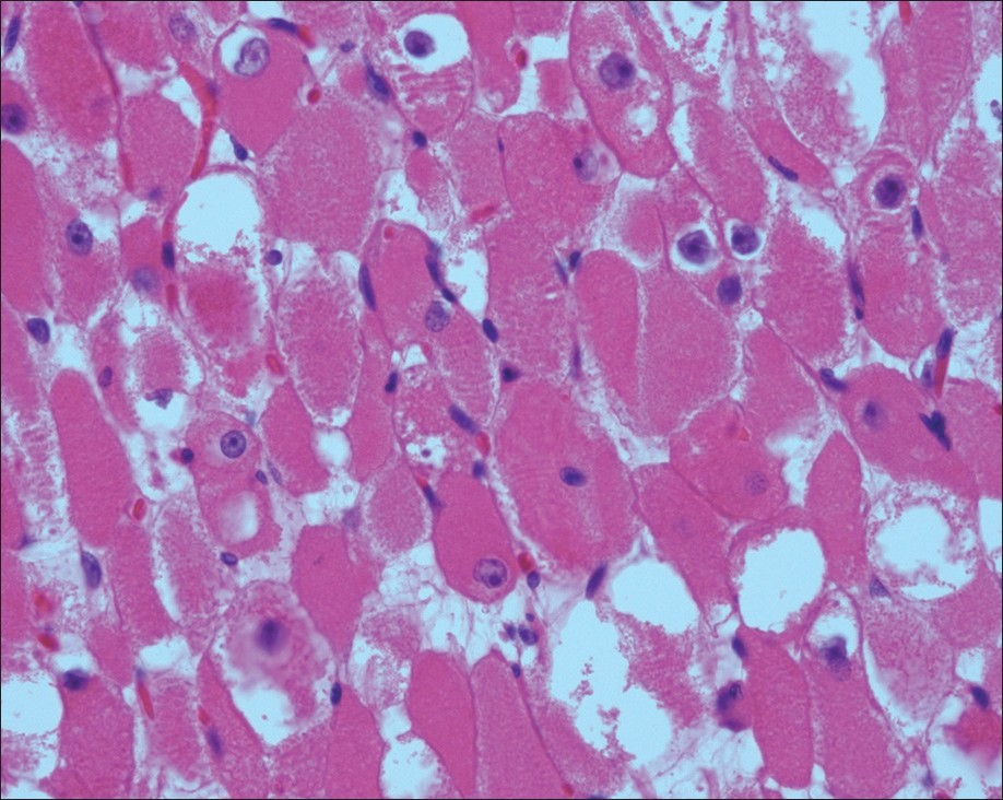 Adult rhabdomyoma. Striations easily identified on the histologic section of the surgical specimen (H and E stain, 400×)