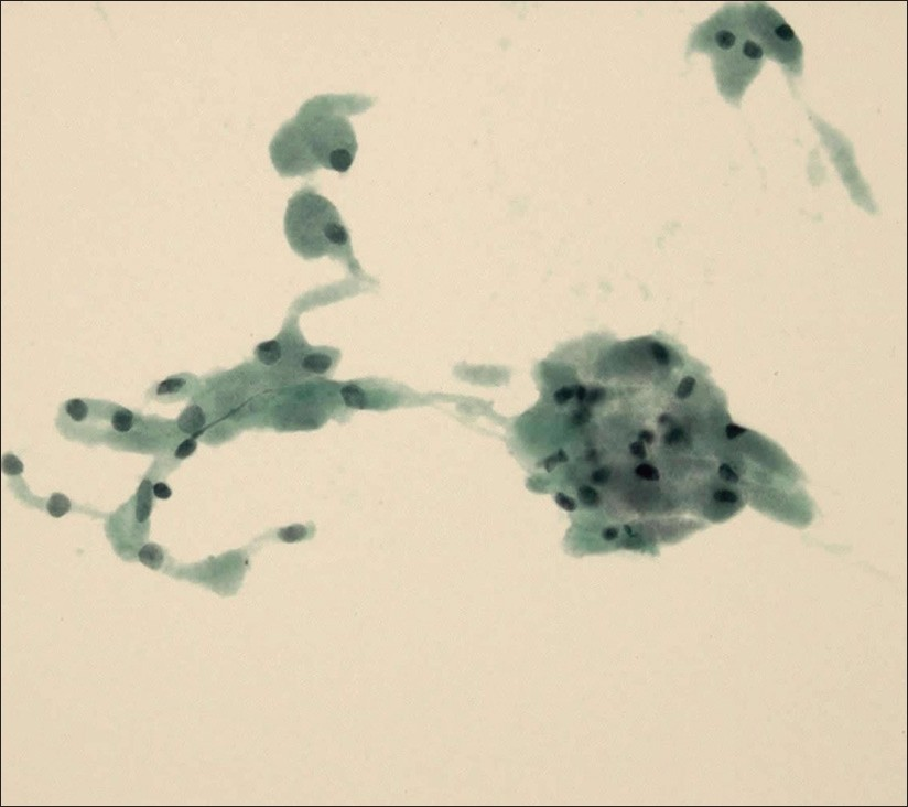 Granular cell tumor. In contrast to adult rhabdomyoma, the cytoplasm is less well defined, soft, and granular (Papanicolaou stain, ThinPrep, 400×)