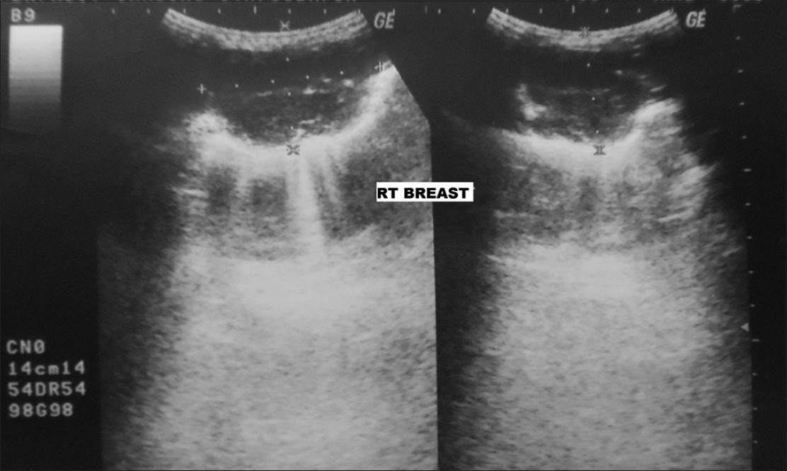 Ultrasound of right breast shows a 5.8 cm × 4.6 cm sized hypoechoic mass with irregular margins