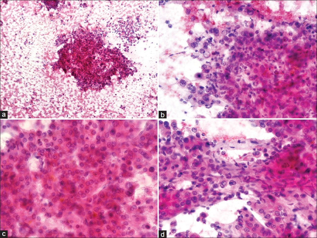 Right breast fine-needle aspiration cytology (FNAC): PAP stain: (a) Cellular aspirate shows numerous naked nuclei and large cohesive fragments of polygonal cells (×100). (b) Cells have enlarged pleomorphic nuclei, prominent nucleoli and dense granular eosinophilic cytoplasm. Tumor cells show intranuclear inclusions (×400). (c) Cells are arranged in trabecular pattern with thick plates of atypical hepatocytes showing bile pigmentation (×400). (d) Cluster of atypical hepatocytes is lined by elongated endothelial cells (×400)