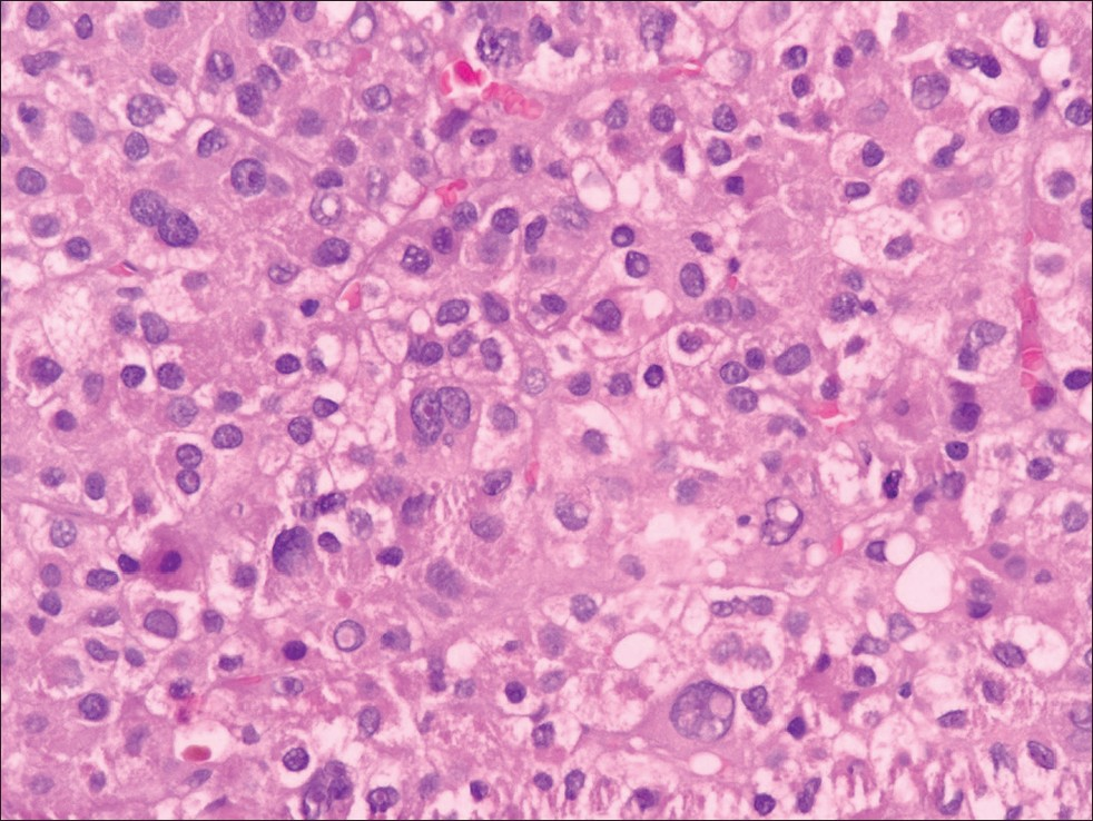 Right breast tru-cut biopsy: Tumor shows trabecular arrangement of polygonal cells having pleomorphic nuclei, occasional prominent nucleoli, intranuclear inclusions and clear to granular amphophilic cytoplasm (Hematoxylin-eosin stain ×400)