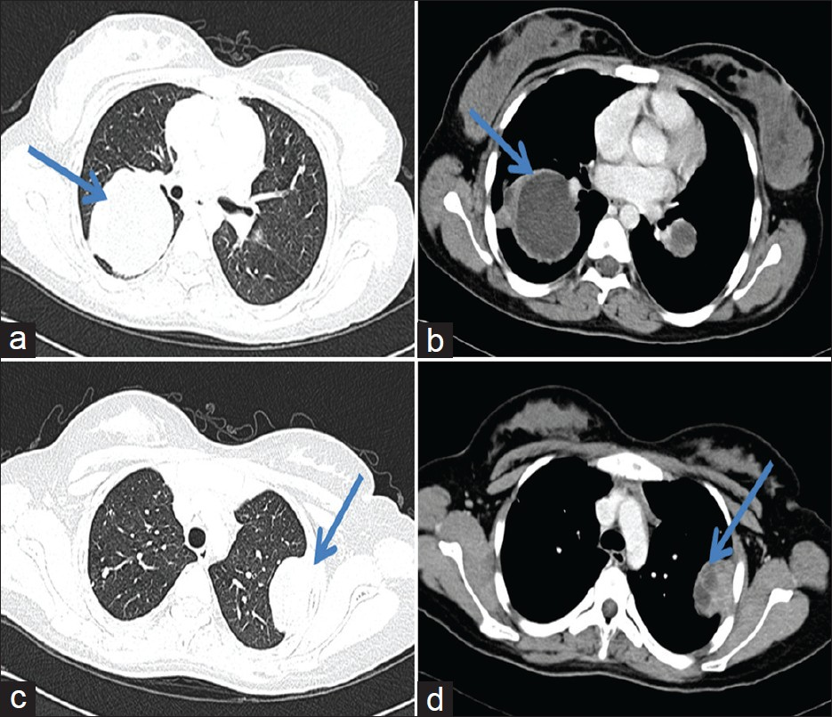 (a-d) CT scan demonstrating lesions in the right middle lobe and left upper lobe, both of which are pleural-based with chest wall invasion