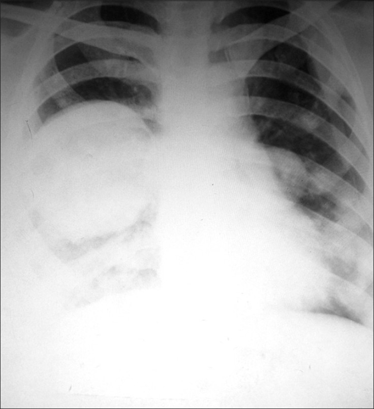 Chest radiograph revealing right-sided lung lesion along with pleural effusion