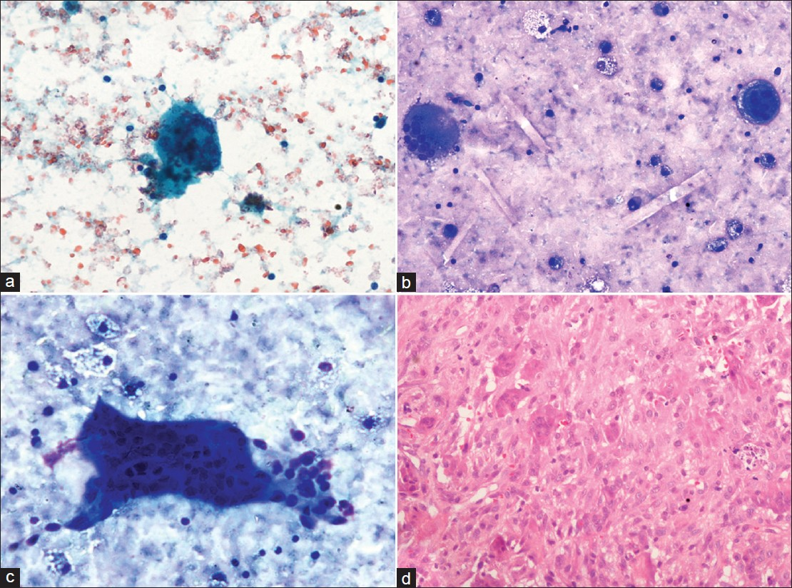 (a-b) Microphotograph of pleural fluid showing osteoclast-like giant cells, with interspersed foamy histiocytes [(a) (Pap, 200×), (b) (MGG, 200×); (c) Osteoclast giant cell sticking to the mononuclear cells (MGG, 400×)]; (d) Biopsy of the lung lesion showing features of giant cell tumor (H and E, 200×)]