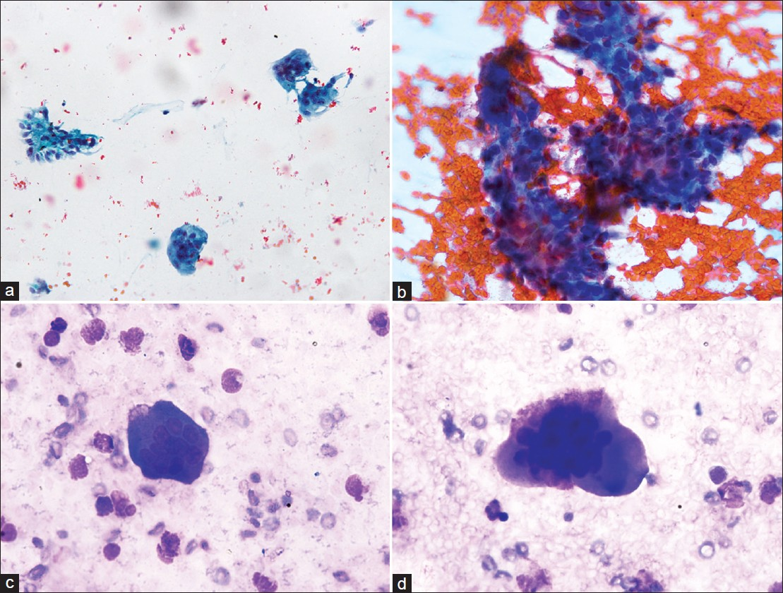 (a) Microphotographs of FNA smears from lung lesion showing osteoclast giant cells along with a stromal fragment (Pap, 200×); (b) Stromal fragment composed of mononuclear cells, with sticking of osteoclast giant cells (Pap, 400×); (c-d) Osteoclast giant cells along with few inflammatory cells (MGG, 400×)